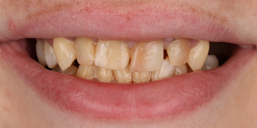 tooth1-before tooth1-before