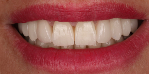 tooth2-after